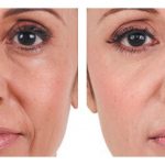 Before and After Dermal Fillers