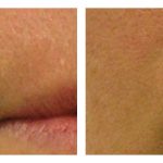 Before and After HydraFacial MD