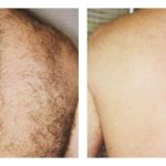 Before and After Laser Hair Removal