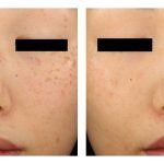 Before and After Laser Skin Treatment