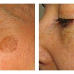 Before and After Laser Skin Treatment