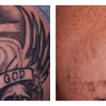 Before and After Laser Tattoo Removal