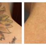 Before and After Laser Tattoo Removal