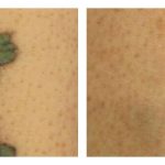 Before and After Laser Tattoo Removal