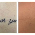 Before and After Laser Tattoo Removal