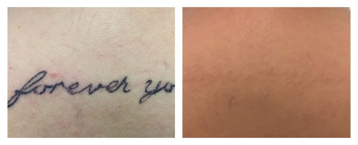 Tattoo Removal Tattoo Removal