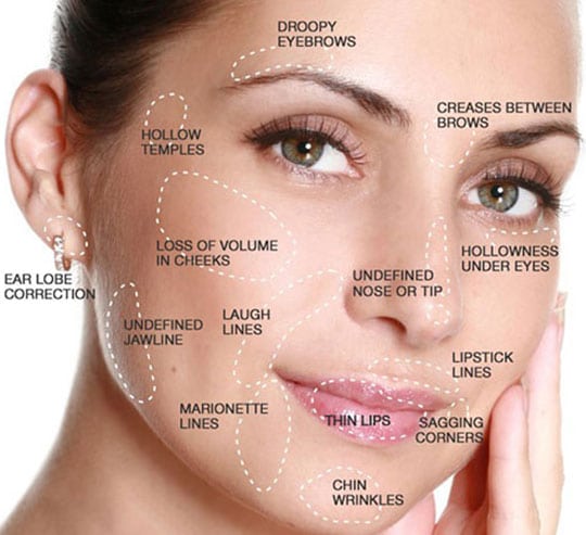 A woman's face showing the different areas to have BOTOX treatment