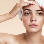 How PicoWay Resolve can reduce acne scarring
