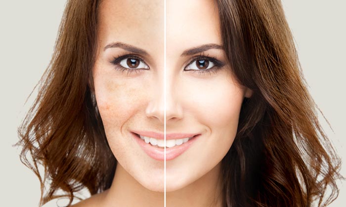 LASER SKIN TREATMENTS