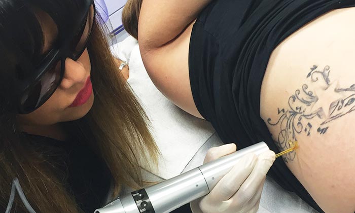 LASER TATTOO REMOVAL