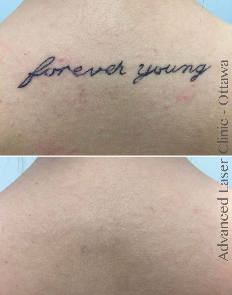 Laser Tattoo Removal Ottawa | Advanced Laser Clinic